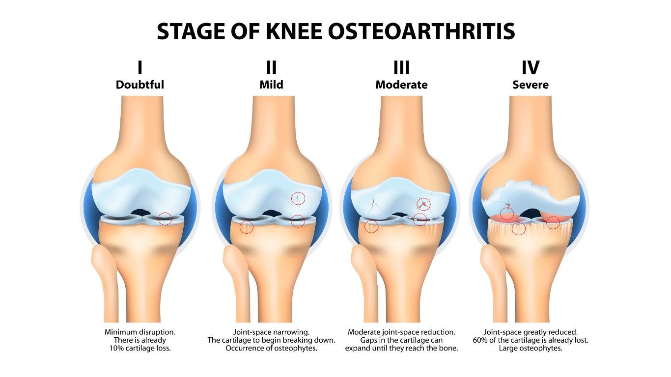 Knee joint affected by osteoarthritis showing cartilage damage