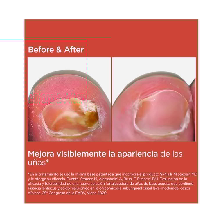SI-NAILS® MicoXpert MD de Isdin