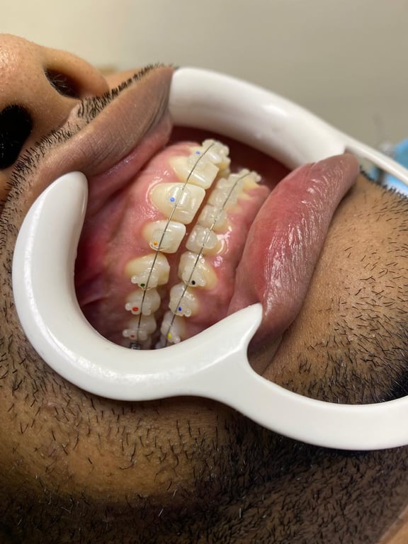 Caso de ortodoncia estética - vista 4