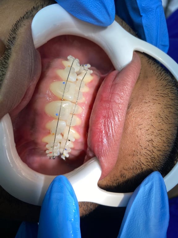 Caso de ortodoncia estética - vista 1