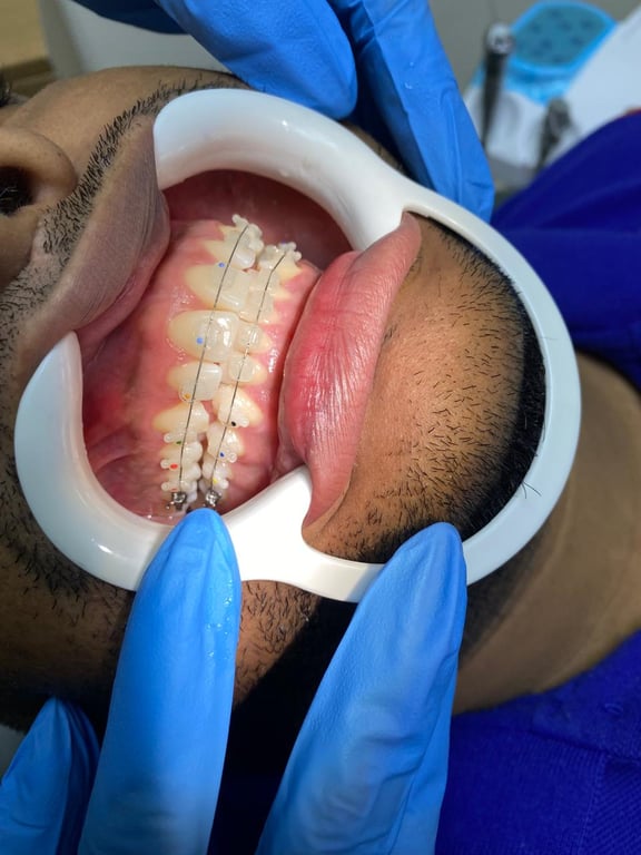 Caso de ortodoncia estética - vista 2