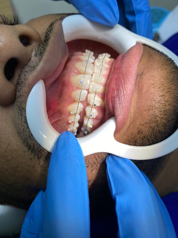 Caso de ortodoncia estética - vista 3