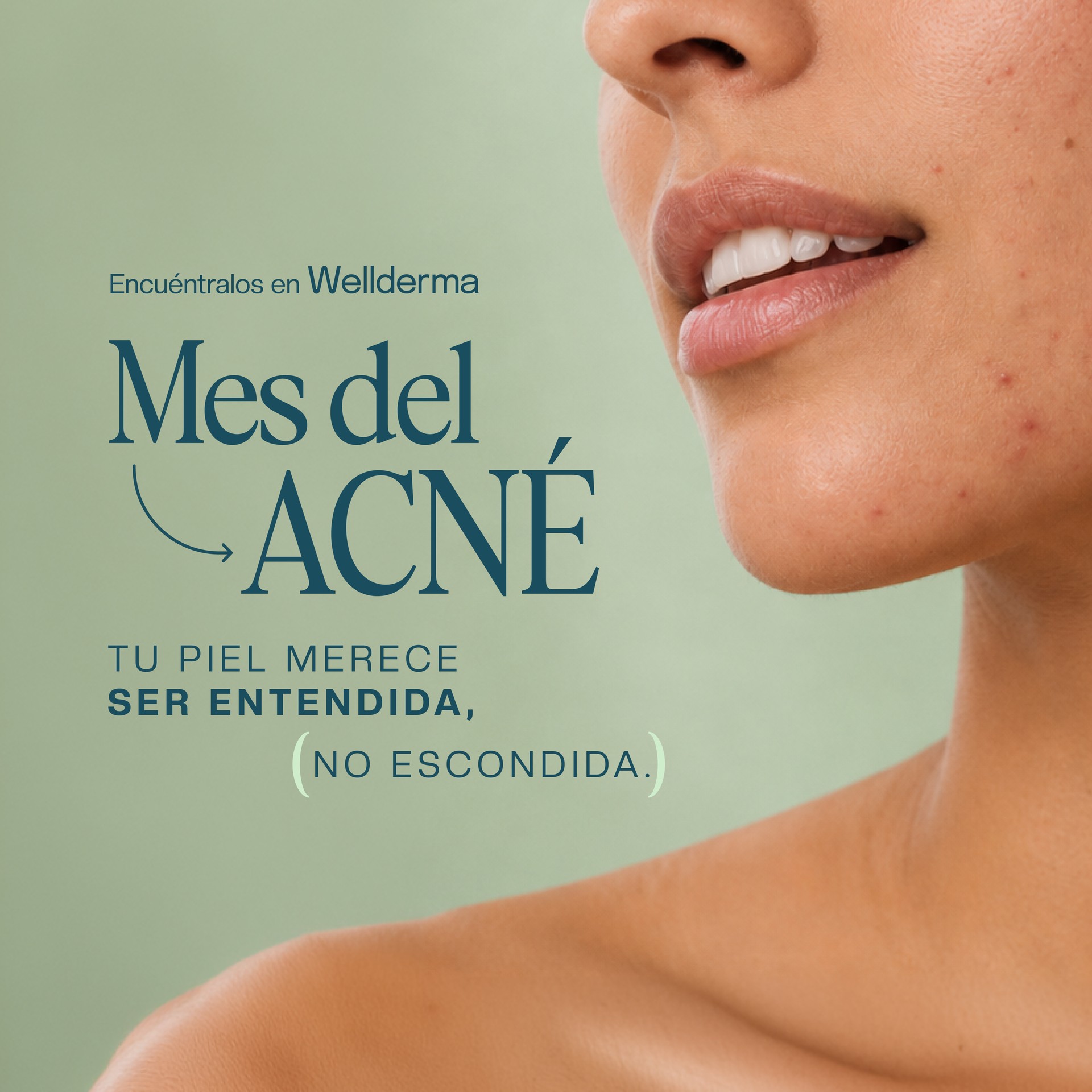 Mes del Acné