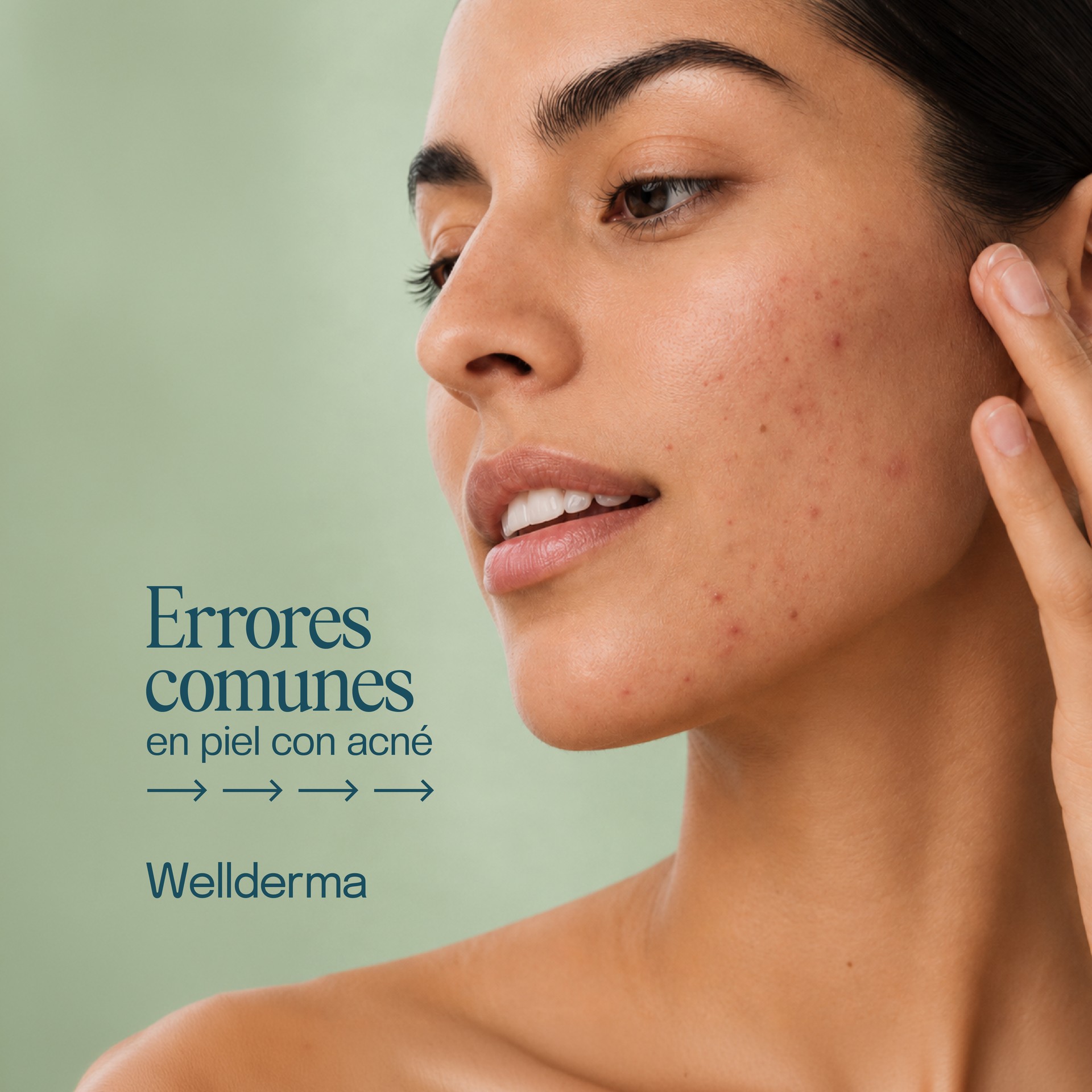 Errores comunes en piel con acné