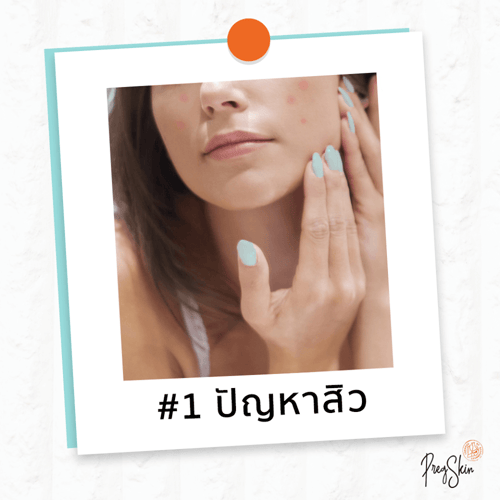 รักษาสิวคนท้อง