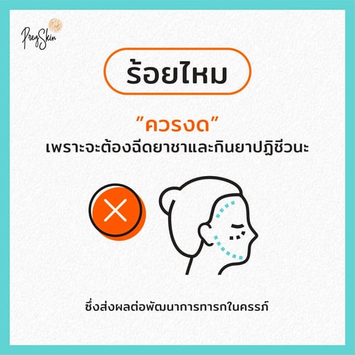 thread lifting for pregnant women