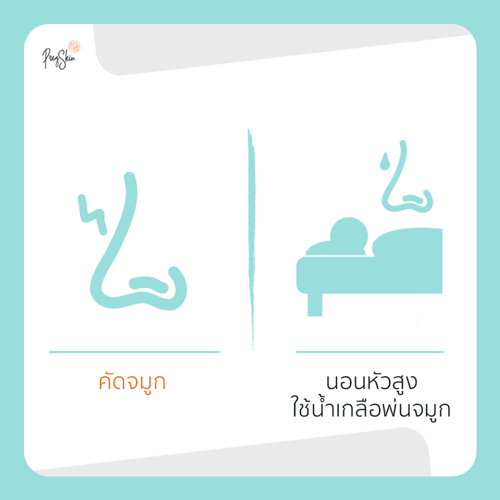 คัดจมูก คนท้อง