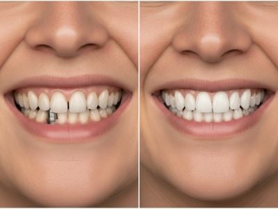 Before Dental Implant Success