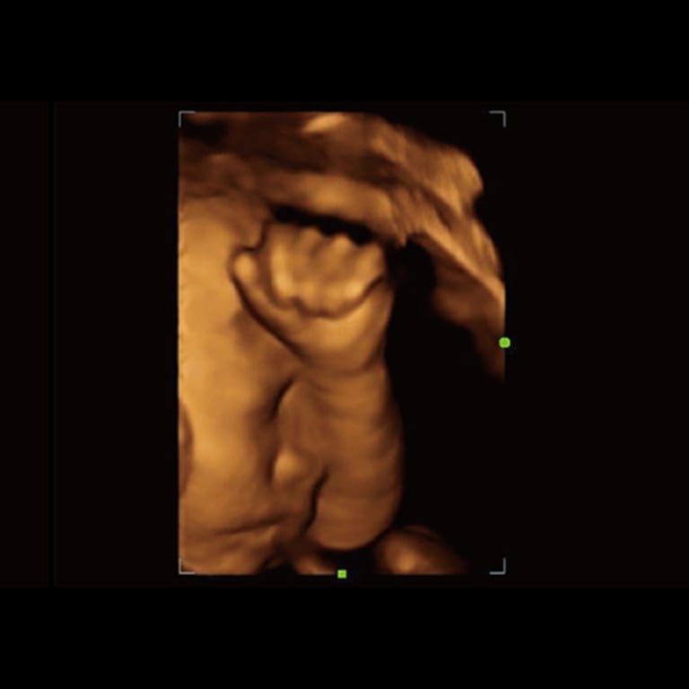 Mindray Z50 portables Einstiegs-Ultraschallsystem 15-Zoll Color Doppler