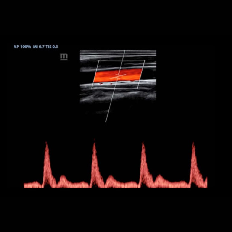 Mindray Z60 Bedienfeld TGC-Regler Trackball