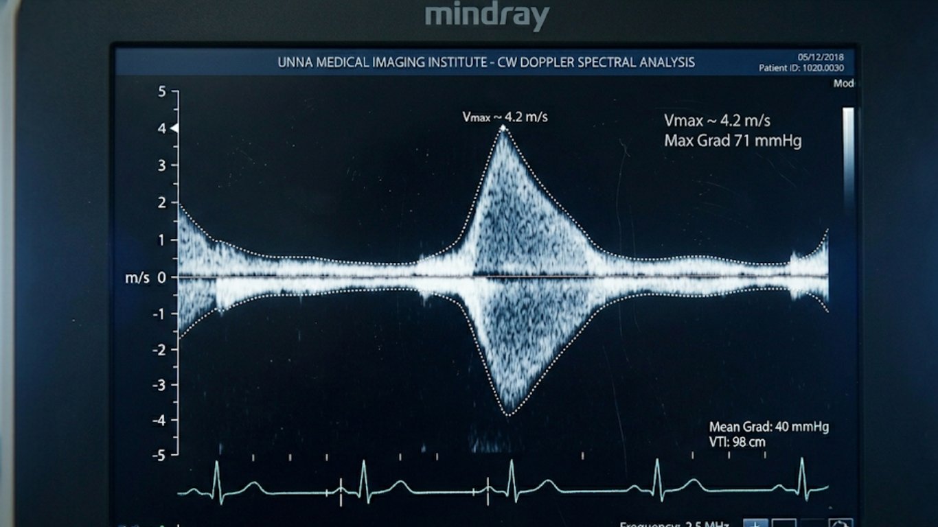 CW-Doppler Echokardiographie — maximaler Jet über hochgradiger Aortenstenose