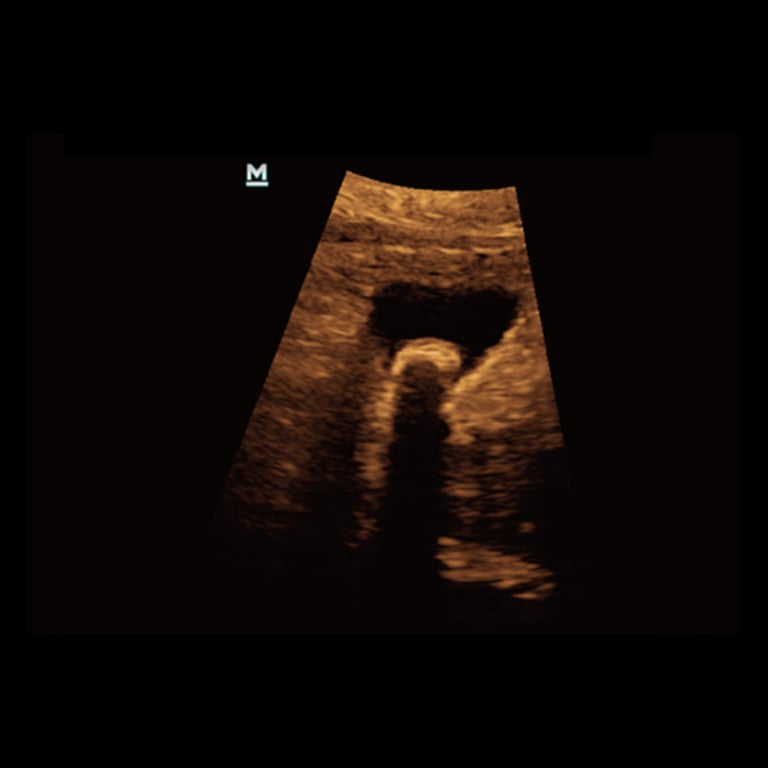 Mindray Z50 Bildbeispiel Abdomen Gynäkologie