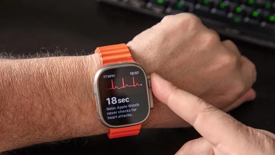 Reloj Inteligente de Doble Sensor Potencia la Detección de Fibrilación Auricular Silenciosa