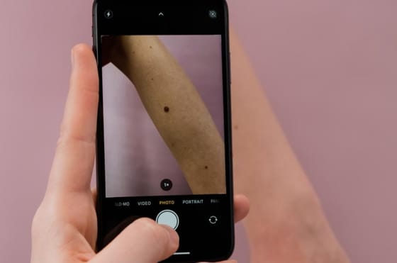 Smartphone-Technologie wird zur Früherkennung von Hautkrebs
