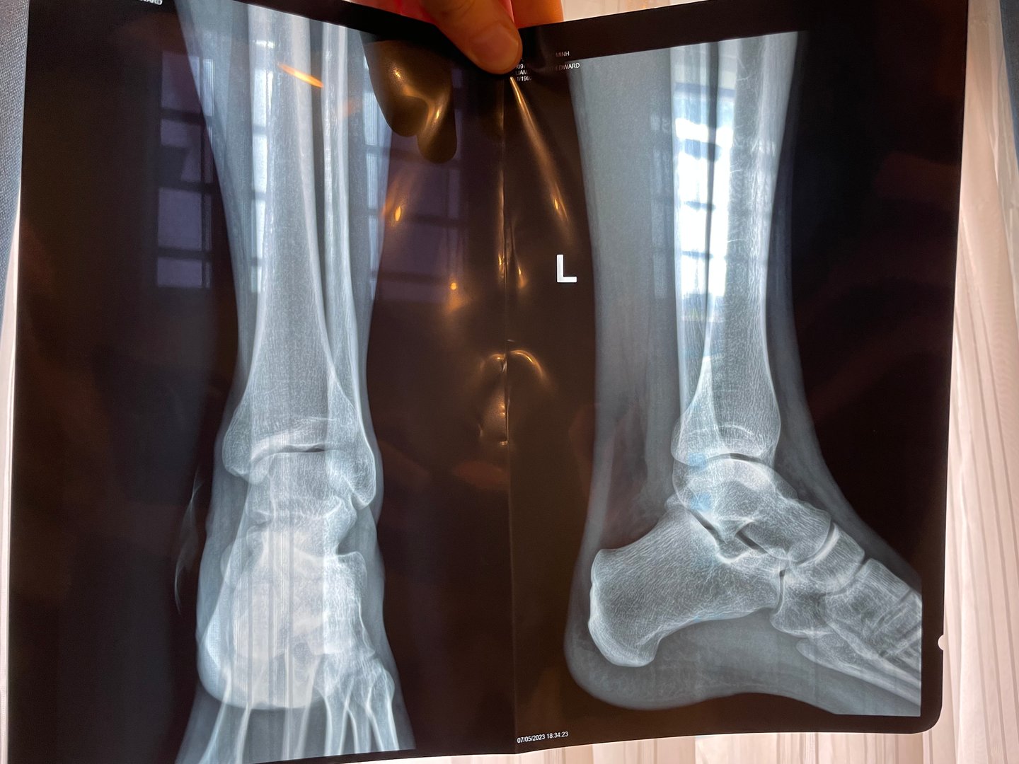 Ankle x-ray