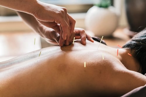 Acupuncture service image