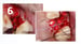 Osteogen Suture Guide 6 thumbnail