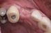 DALI Flex Graft for Buccal Augmentation Deficiency 4 thumbnail