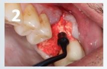Osteogen Suture Guide 2