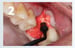 Osteogen Suture Guide 2 thumbnail