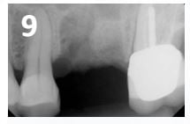 Osteogen Suture Guide 9