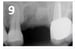 Osteogen Suture Guide 9 thumbnail