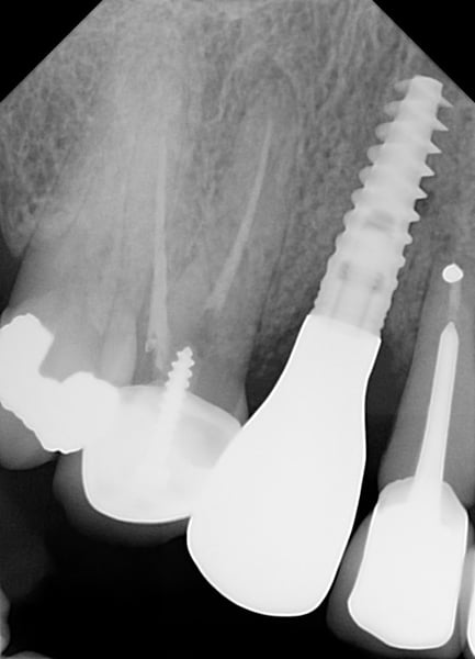 DALI Flex Graft for Buccal Augmentation follow up 10