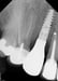 DALI Flex Graft for Buccal Augmentation follow up 10 thumbnail