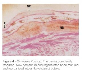 Cytoflex Resorb Post Op 2