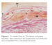 Cytoflex Resorb Post Op 2 thumbnail