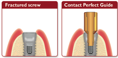 fractured screw diagrame