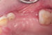 tension relief 1 thumbnail