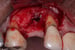 DALI Flex Graft for Buccal Augmentation Uncovery 5 thumbnail
