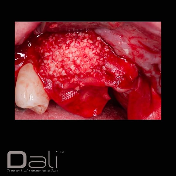 DALI Mineralized Cortical Cancellous Graft Case