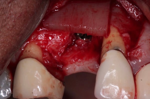 DALI Flex Graft for Buccal Augmentation