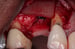 DALI Flex Graft for Buccal Augmentation placement 6 thumbnail