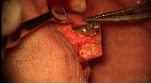 Osteogen Strip Case Implant