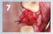 Osteogen Suture Guide 7 thumbnail