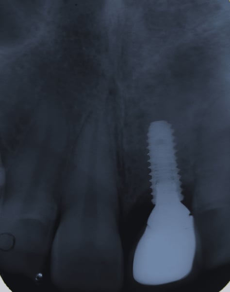 Implants in the Esthetic Zone