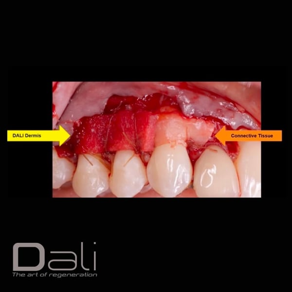 DALI Dermis Case 2