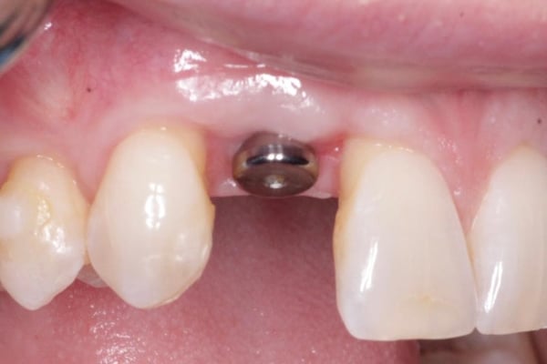 Tissue Contour: Have Some Patience