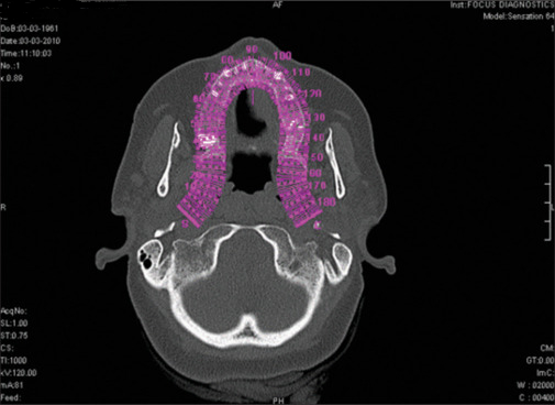 CBCT predicting implant stability