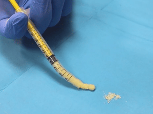 RAPTOS Prefilled Graft Syringe: Mineralized Cortico-Cancellous Blend