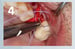 Osteogen Suture Guide 4 thumbnail
