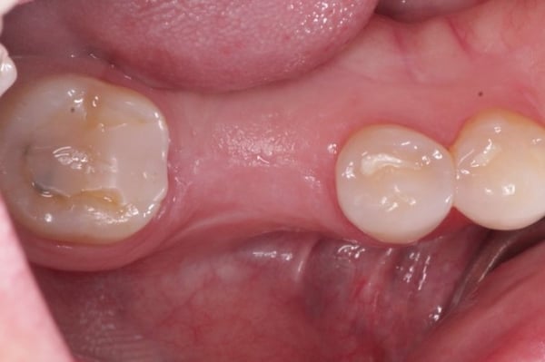 Improving Emergence Profile with DALI Dermis