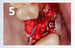 Osteogen Suture Guide 5 thumbnail