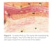 Cytoflex Resorb Post Op 1 thumbnail