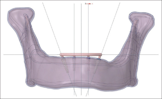 4 or 6 Implants
