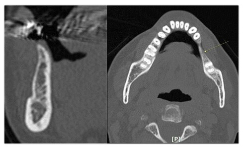 cbct preop ridge augmentation