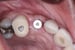 DALI Flex Graft for Buccal Augmentation follow up 9 thumbnail
